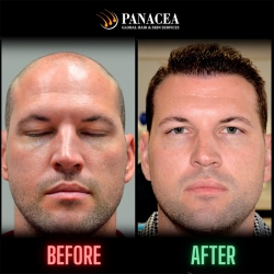 Hair Transplant Treatment in Delhi